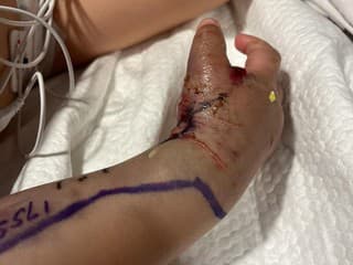 Boj o život dvojročného