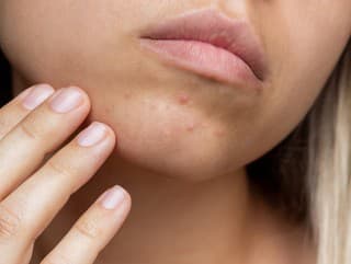 Trápia vás vyrážky na