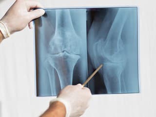 Odborníci varujú: Pri chudnutí