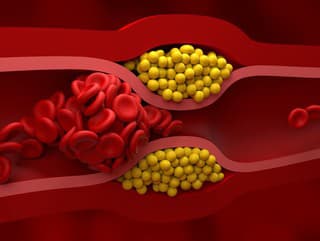 Neviditeľný cholesterol? MÔŽETE o
