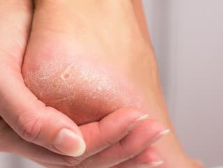 Tvrdé päty a suchá