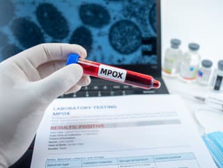 Dobrá správa! Opičie kiahne