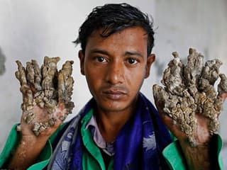 Syndróm stromového človeka desí