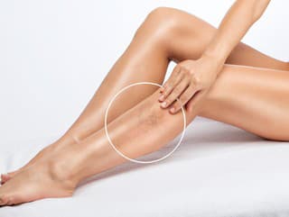 Cievkové metličky: Prečo vznikajú