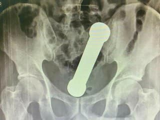 Muž si strčil činku