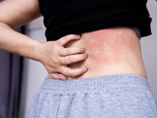 Výživa pri ekzéme: Čo