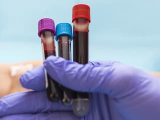 Nezvyčajné príznaky nedostatku železa: