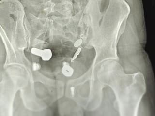 Mužovi operovali žalúdok plný