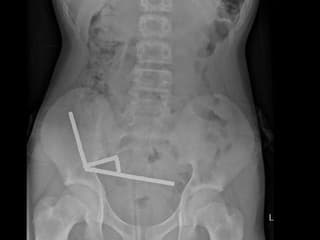 Magnety spôsobovali odumieranie tkaniva.