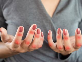 TOUTO chorobou trpí aj