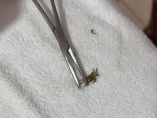 Chlapcovi z ucha vytiahli