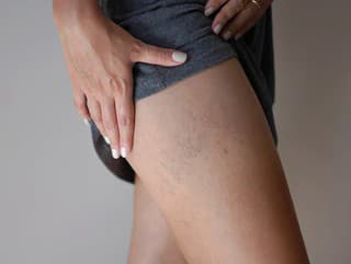 Cievne metličky na stehnách: