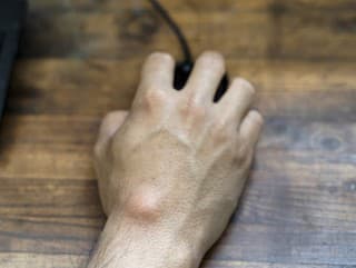 Ganglióm: čo to je,