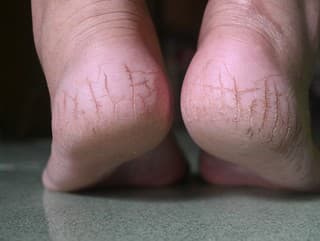 Koniec popraskaným pätám: Viac