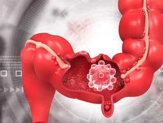 Rakovina hrubého čreva u