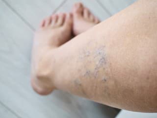 Kŕčové žily: Ako sa