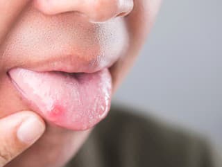 Bolestivé vyrážky na jazyku: