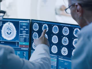 Prvé príznaky Alzheimerovej choroby