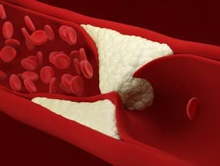 Vysoký cholesterol: Tieto návyky