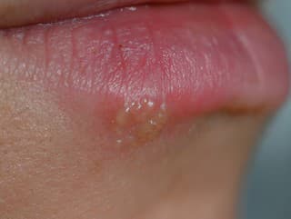 Herpes na pere nie