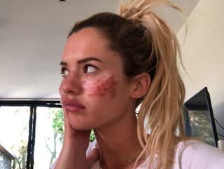 Tilly má jazvy aj
