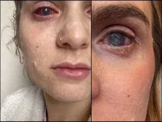Jaqueline si vzala ibuprofén