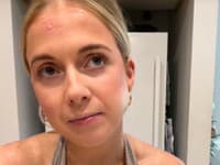 Mamičku (32) znepokojila zdanlivo obyčajná vyrážka na čele: Po roku prišla ŠOKUJÚCA diagnóza! Vôbec nechápala