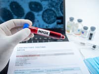 Svetom hýbe smrtiaci vírus: Nový kmeň sa prenáša aj kvapôčkovou infekciou, symptómy sú podobné obyčajnej chrípke!