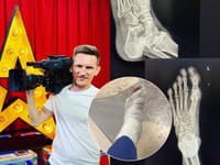 Malý Mišo sa vážne zranil