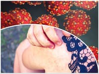 MIMORIADNE V Nitre potvrdili ďalší prípad osýpok! Ide o 35-ročnú osobu