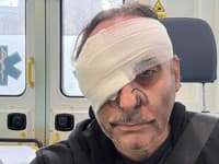 DESIVÉ zranenie slovenského speváka: Pri vystúpení takmer prišiel o oko!