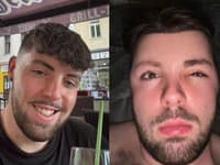 Ignoroval odporúčanie lekárov po transplantácii a prišla krutá daň: Tvár mu opuchla na nepoznanie!