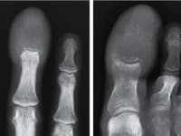 Myslel si, že má len zápal prsta, no realita bola desivejšia: Mužovi (†55) zostali len tri týždne života!