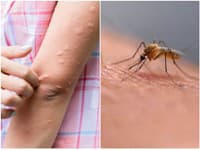 Vedci odhalili prekvapivú súvislosť: Zapáchajúce ponožky a štípance od komárov idú ruka v ruke