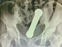 Nehoda pri sebauspokojovaní: 54-ročný muž skončil na operačnom stole! NEUVERITEĽNÉ, čo si strčil do zadku