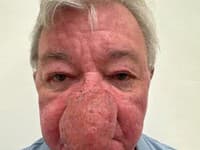 Mužovi choroba zmenila tvár na nepoznanie: To je ale NOS! Pivo ani bozky si roky neužil, lekári museli konať