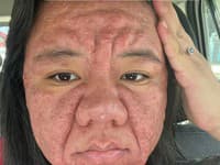 Šokujúca zmena tváre počas tehotenstva: VIDEO Žena sa nemohla pozrieť do zrkadla! PREBOHA, to ako vyzerá?