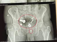 Muža strašne bolelo brucho: Budete v šoku z toho, čo mu tam lekári našli! FOTO po operácii