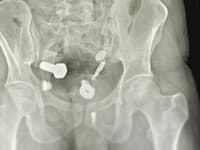 Muž prišiel do nemocnice so silnými bolesťami brucha: Lekári zostali v šoku, keď zistili, čo mal v žalúdku!