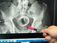 Muž prišiel do nemocnice s OBROVSKÝMI bolesťami: Lekári v ňom našli niečo, ČO nikto nečakal! On tvrdí, bola to NEHODA