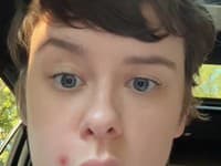 Nevinná vyrážka spôsobila ochrnutie: Žena skončila v nemocnici! Lekári varujú, v ZÓNE SMRTI si ich nikdy nevytláčajte