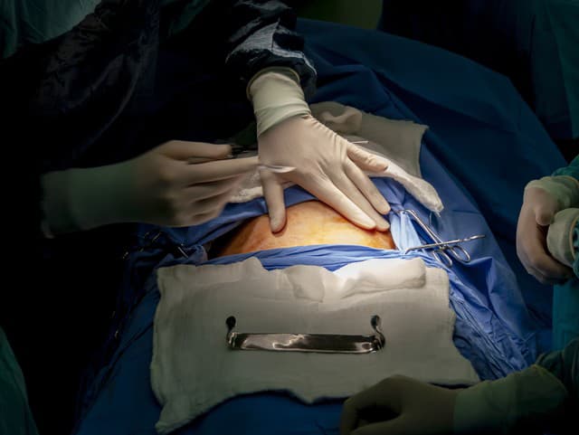 HRÔZA po cisárskom reze!