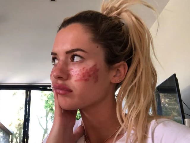 Tilly má jazvy aj