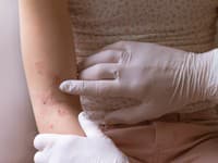 Každý deň musí vysávať vlastnú posteľ: Sharn (38) ODPADÁVAJÚ kusy kože! Môže za to obyčajný krém