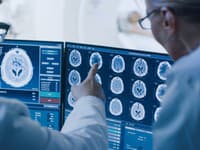 Prelom v boji proti rakovine mozgu: Nový test dokáže odhaliť nádor za pár minút