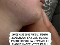 Dcéru Daniely Nízlovej trápil dva mesiaci fľak na líci. 
