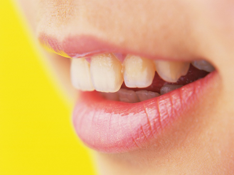 Кривые зубы у подростков. Оранжевые зубы. Отбеливание зубов до и после. Красивая улыбка зубы. Красивые зубы.