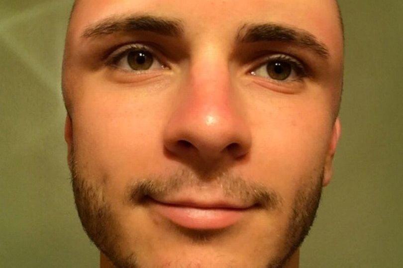 Mladík si oholil hlavu a strávil na slnku 14 hodín FOTO doživotnej