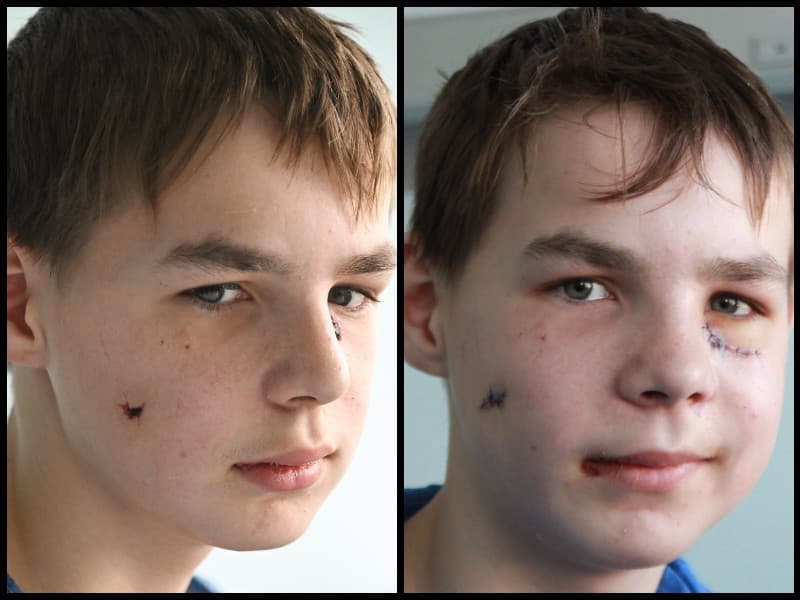 Chlapec pred (vľavo) a po operácii v UNB.