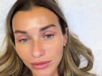 Natália Végh podstúpila estetický zákrok. 